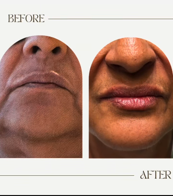 Dermal Fillers